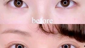 做双眼皮视频,跟随视频教程轻松变美