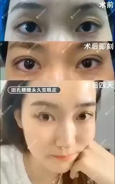 做双眼皮视频,跟随视频教程轻松变美