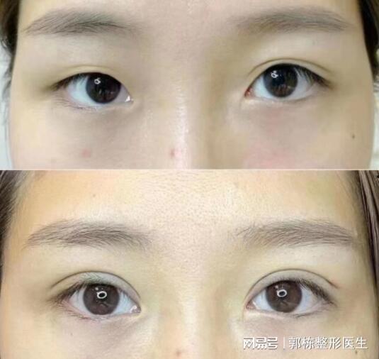 做双眼皮视频,跟随视频教程轻松变美